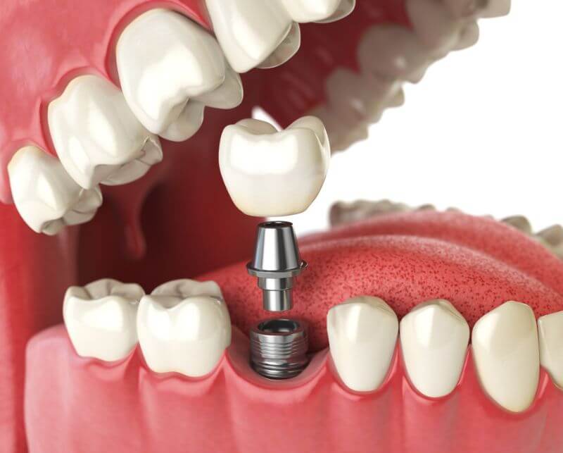 come funziona impianto dentale arzergrande