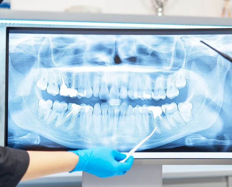 tac digitale per impianto dentista arzergrande